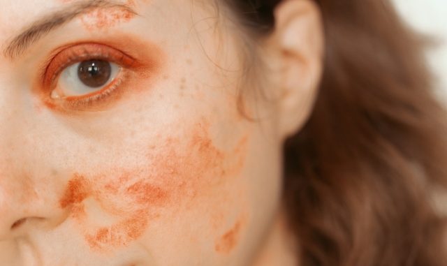 Acné et peau
